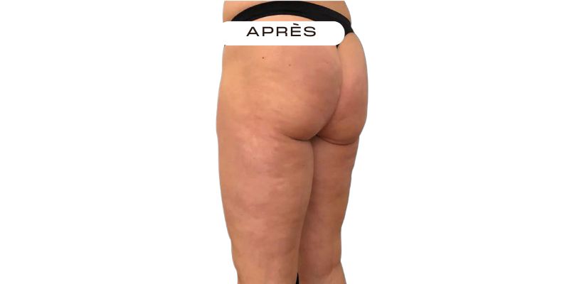 Après Emtone — Fesses & cuisses — Résultats après 6 séances