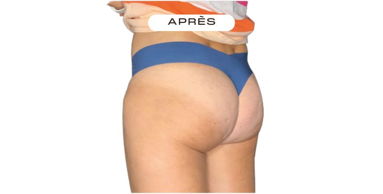 Après Emtone — Fesses — Résultats après 6 séances