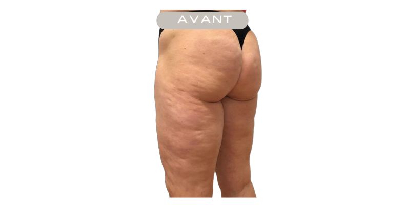 Avant Emtone — Fesses & cuisses — Résultats après 6 séances