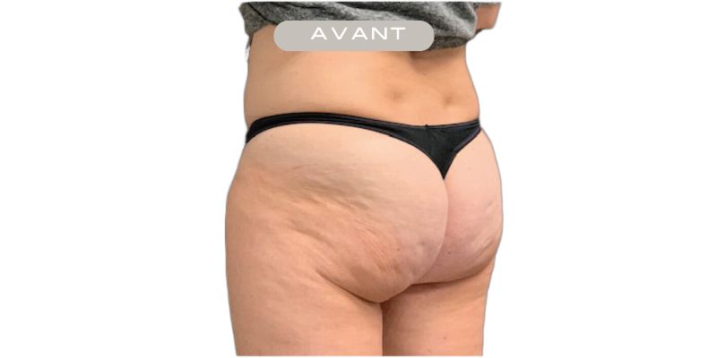 Avant Emtone — Fesses — Résultats après 6 séances